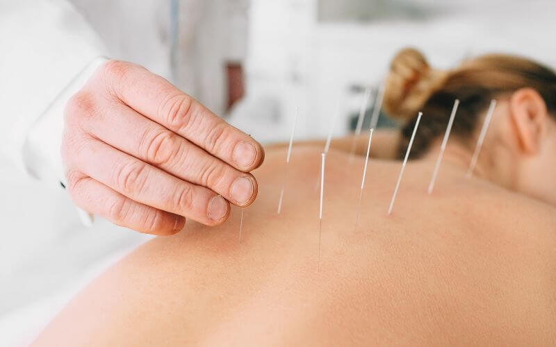 The Concept of Natural Healing Acupuncture: Exploring its Origins and Principles