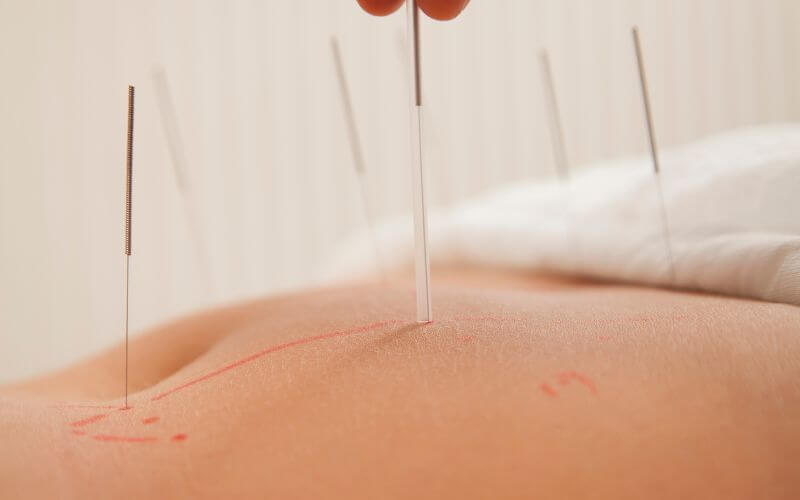 Understanding the Techniques and Methods of Natural Healing Acupuncture